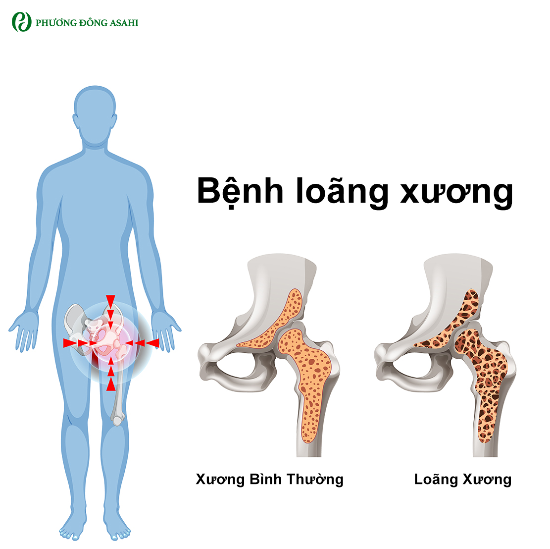 Nguyên nhân gây loãng xương: Tìm hiểu sớm để ngăn ngừa kịp thời